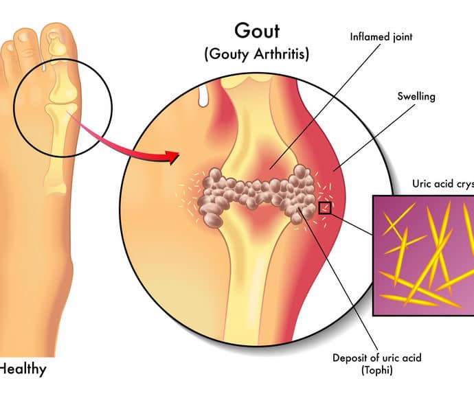 Dna moczanowa – objawy, dieta i leczenie podagry