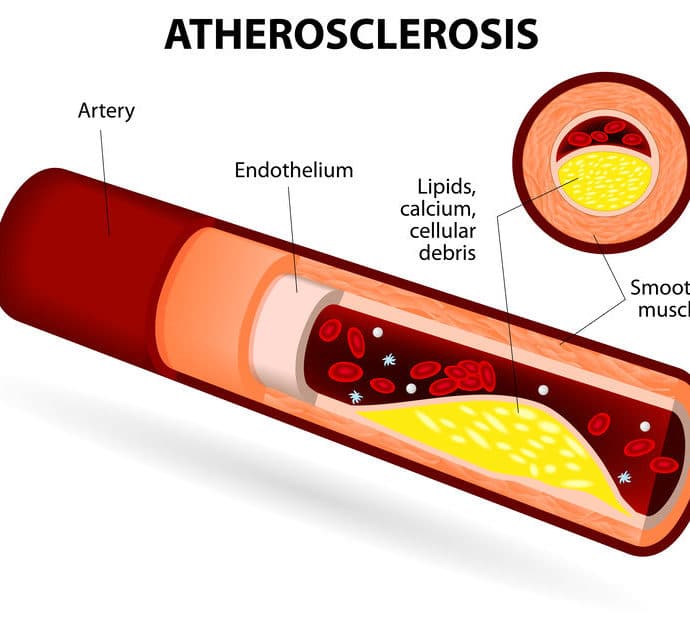 Miażdżyca – przyczyny, objawy i leczenie