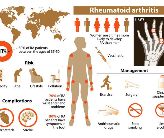RZS – objawy, leczenie i dieta