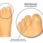 Domowe sposoby na grzybicę paznokci grzybica paznokci