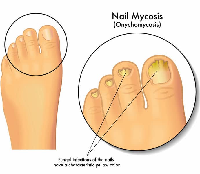 Domowe sposoby na grzybicę paznokci
