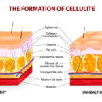 cellulit